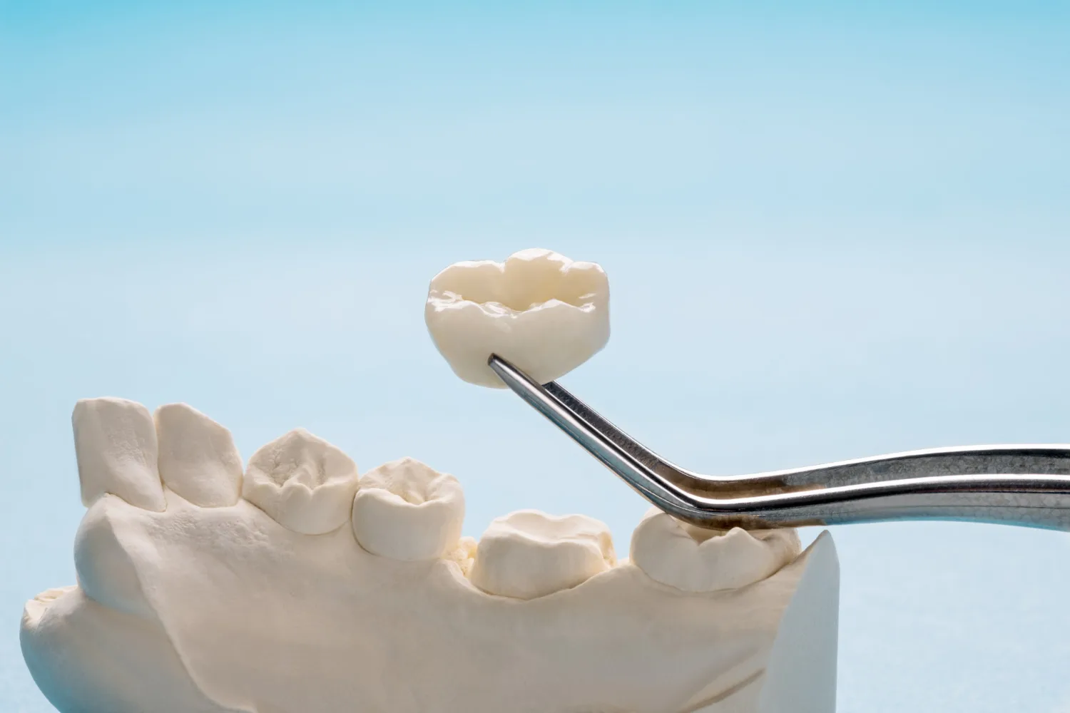 Same Day Dental Crowns