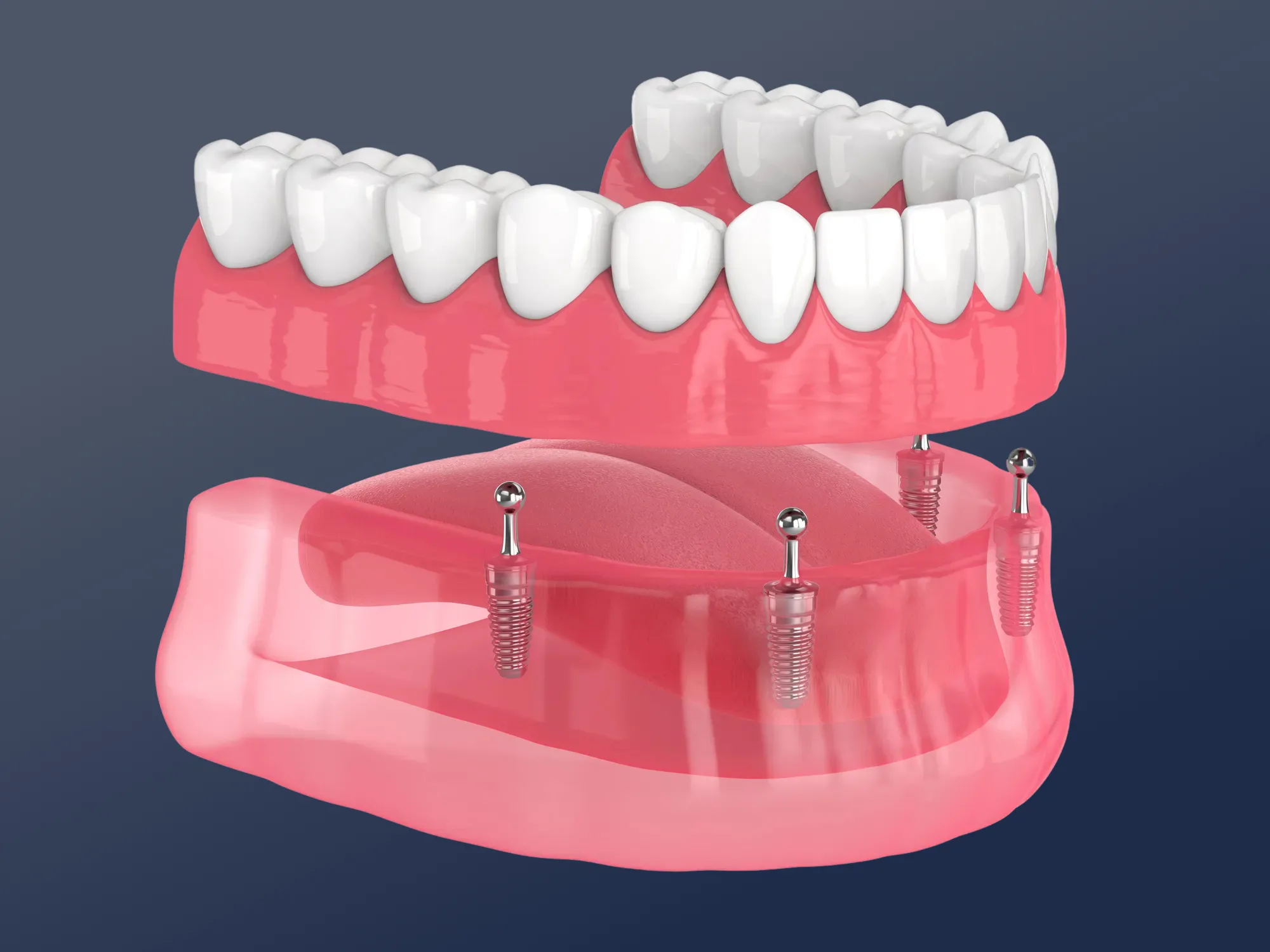 Dentures