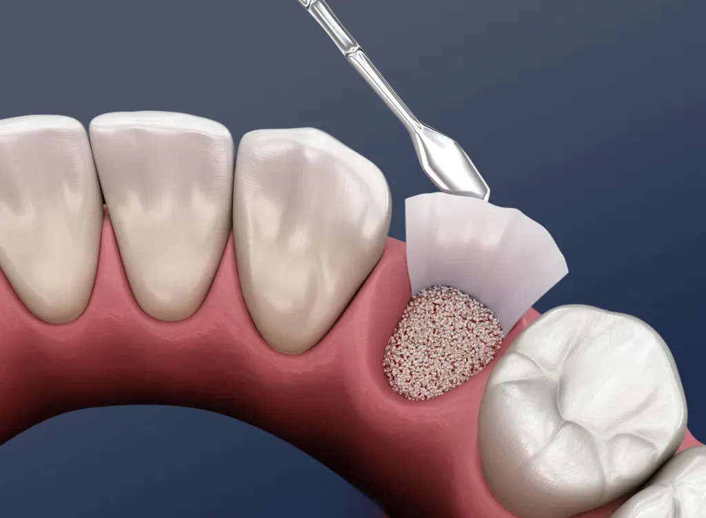 Bone Grafting