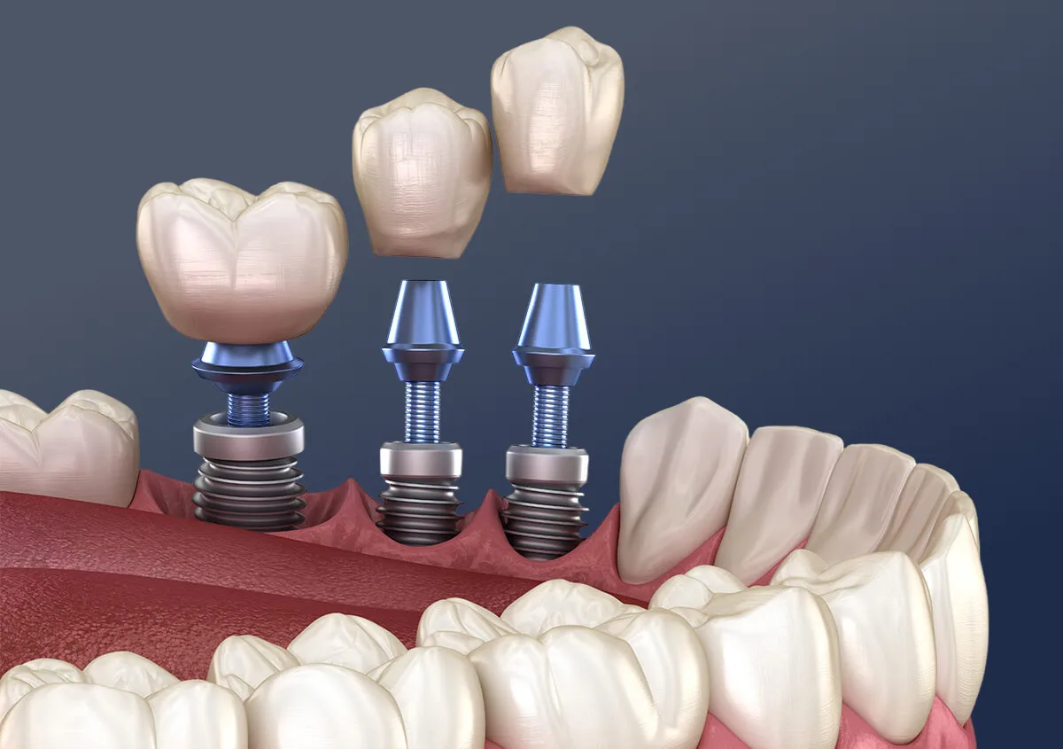Implant Crown Restoration
