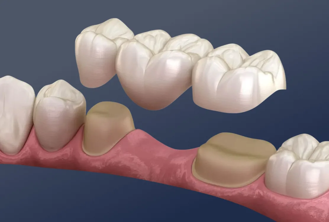 Dental Bridges