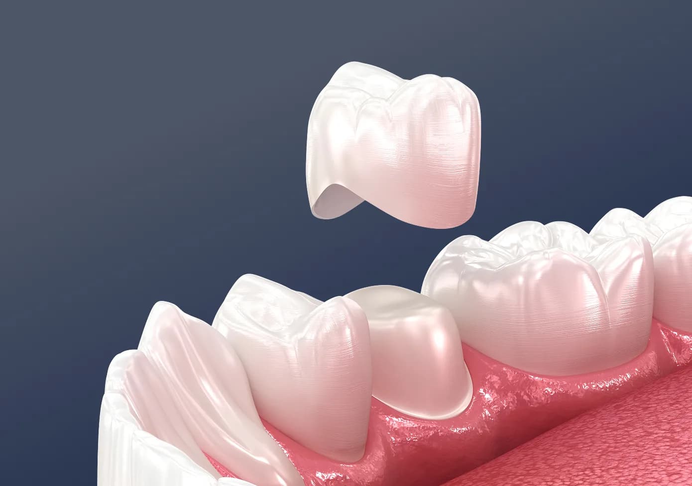 Same Day CEREC Crowns
