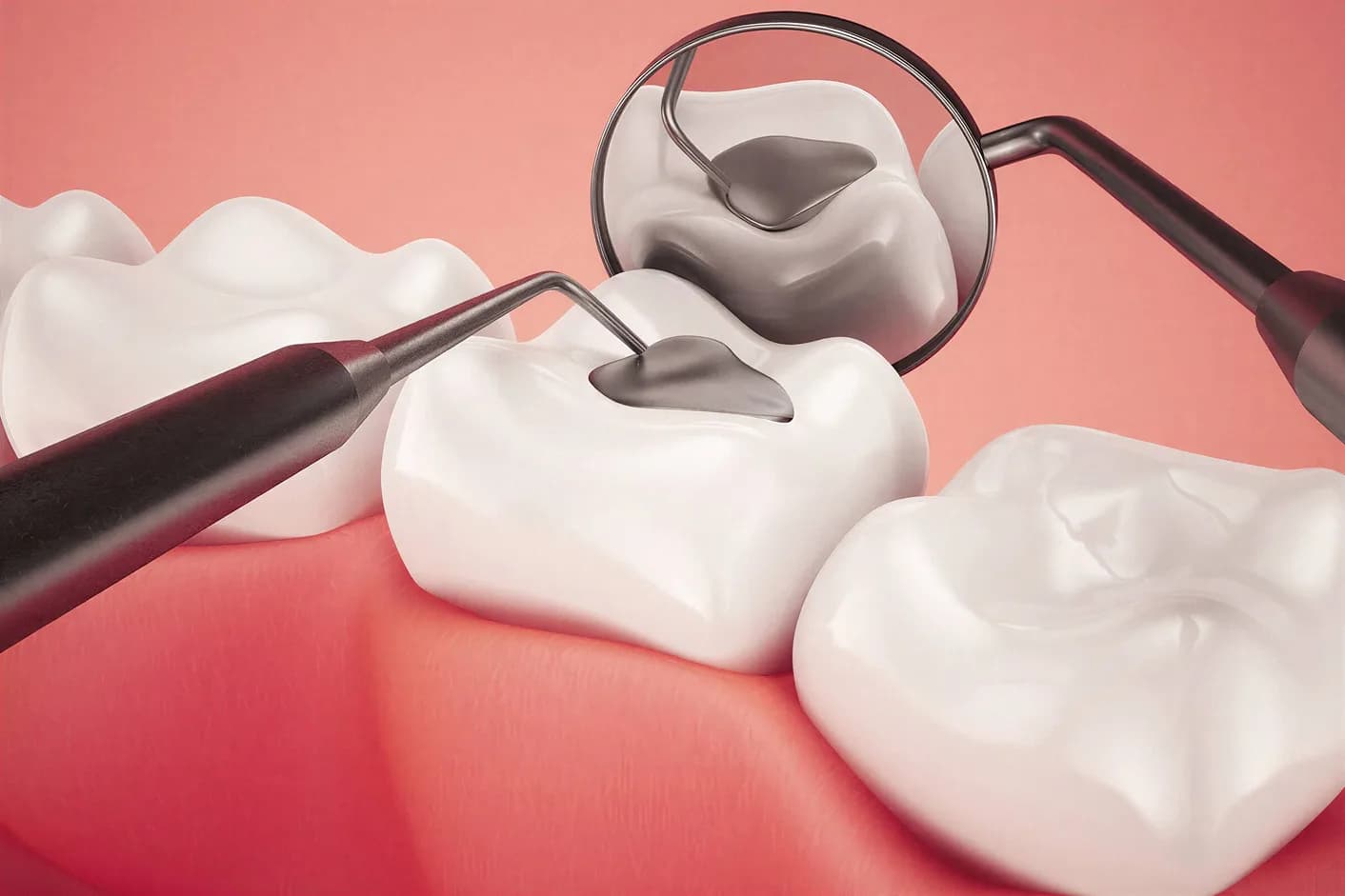 Lost or Loose Fillings